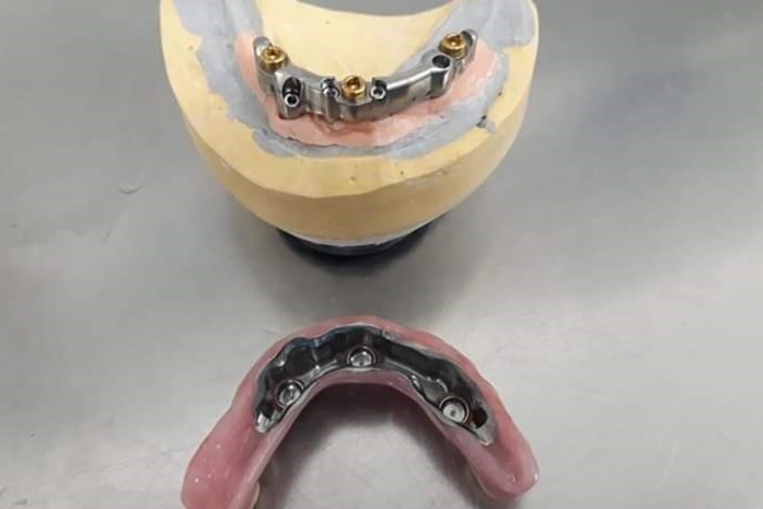 implant retained removable denture
